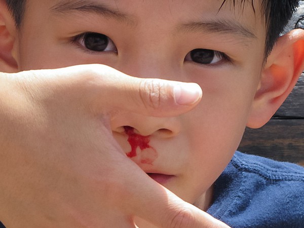 Носові кровотечі у дітей