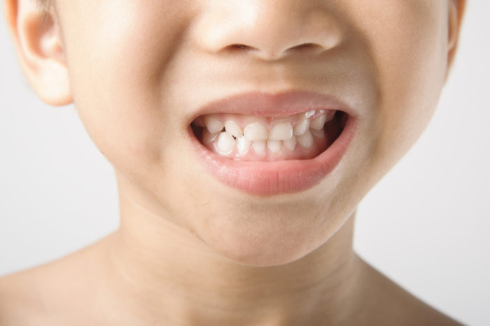 плями на дитячих зубах