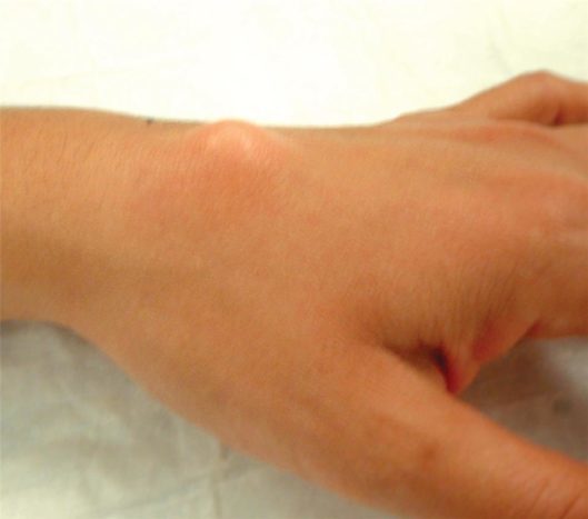 Ганглієва кіста верхнього зап'ястя (джерело: Американське товариство хірургії руки)