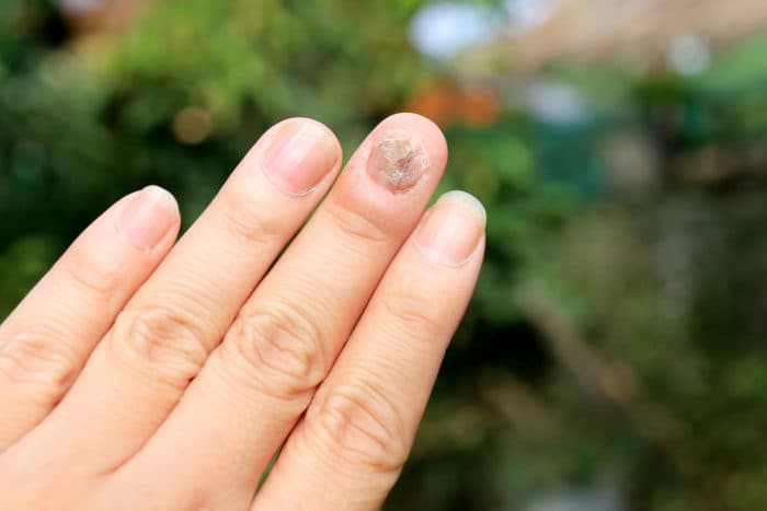 грибкова інфекція нігтя