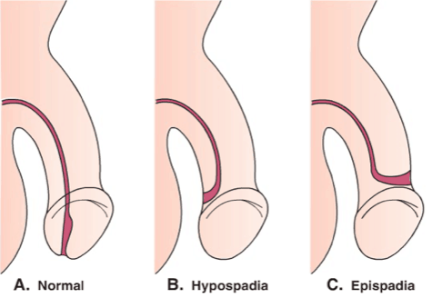 дірка статевого члена не нормальна, епізоди гіпоспадії