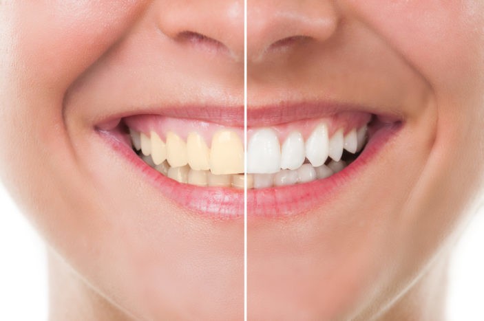Побічні ефекти відбілювання зубів при відбілюванні