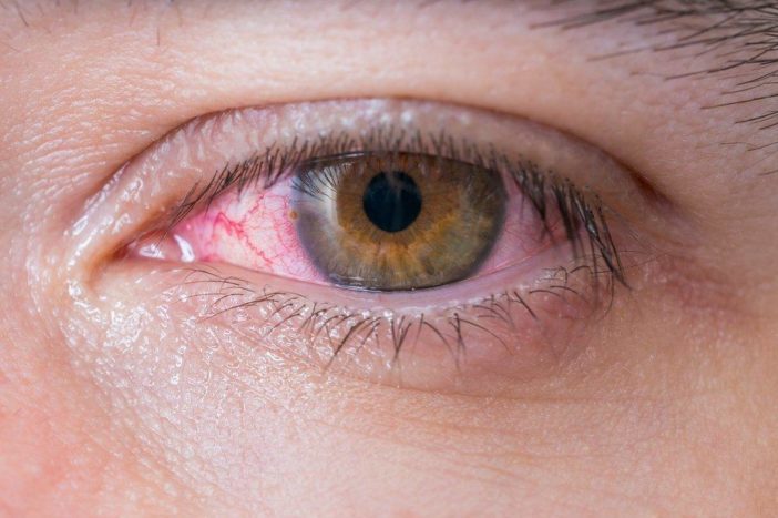 алергічний кон'юнктивіт червоних очей