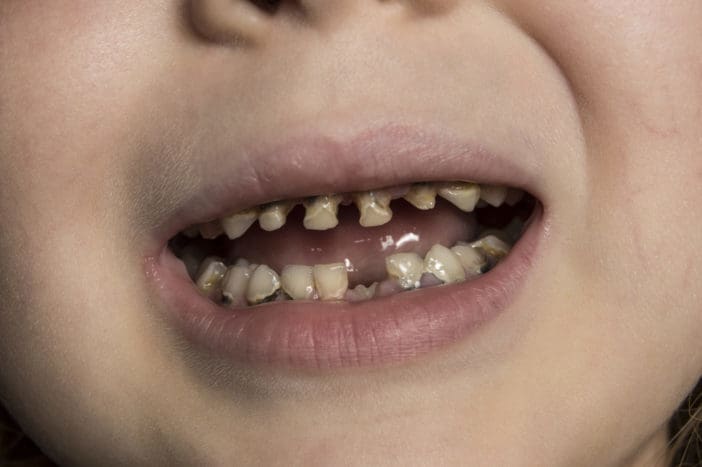 дитячі пляшки зуба карієсу для дитячого карієсу