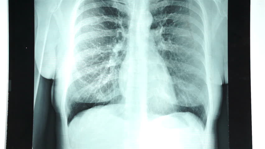 рентген грудної клітки