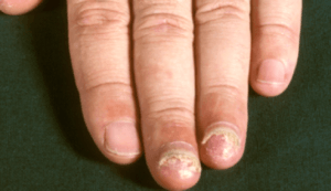 крихкі нігті