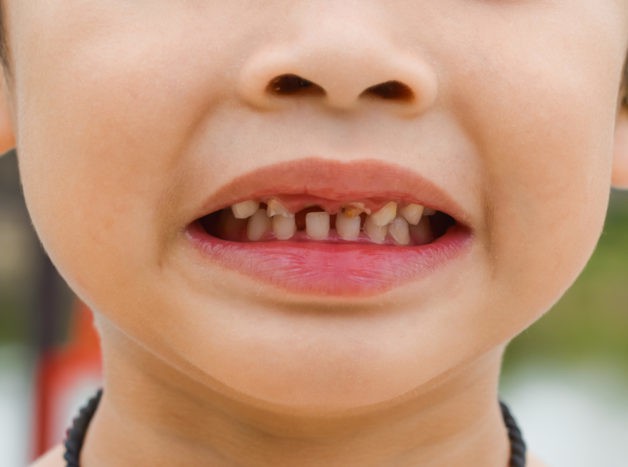 пошкодження дитячих зубів