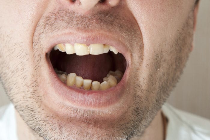 як запобігти винен зубного каменю